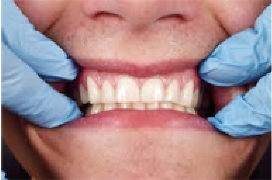 3. Stops Gum Bleeding in Days